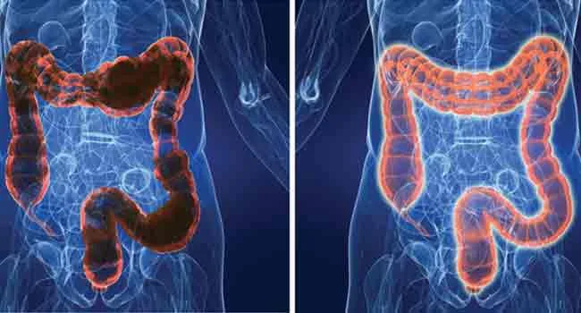 Colonic Hydrotherapy